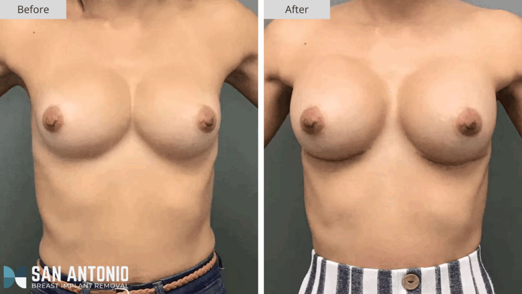 San Antonio Breast Implant Removal Patient #1