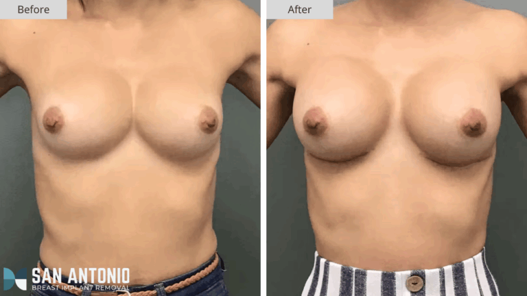 San Antonio Breast Implant Removal Patient #1