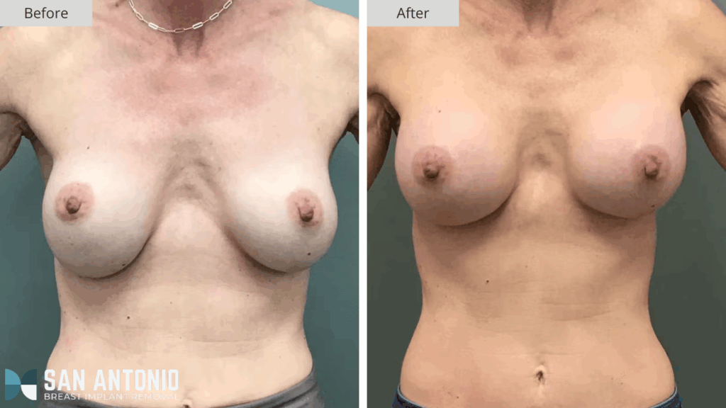 San Antonio Breast Implant Removal Patient #2