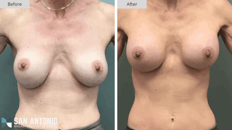 San Antonio Breast Implant Removal Patient #2