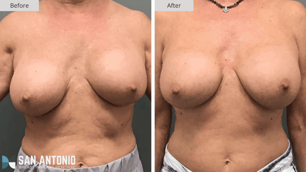San Antonio Breast Implant Removal Patient #3