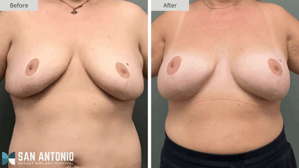 San Antonio Breast Implant Removal Patient #4