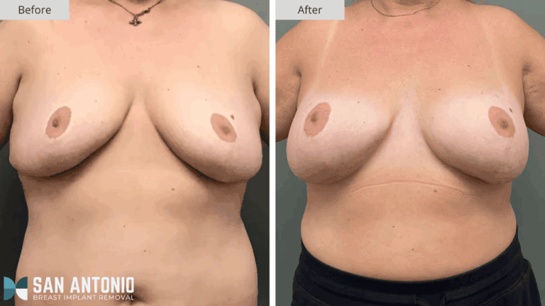 San Antonio Breast Implant Removal Patient #4